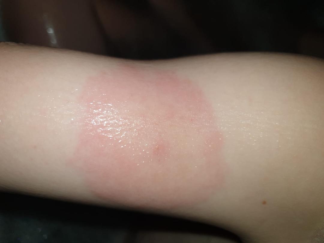 Bull's eye rash on child (from patient).jpg