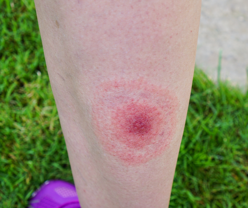 lyme disease rash.png